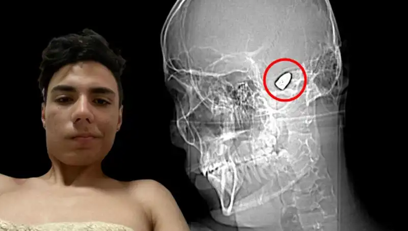Kafasında Patlamaya Hazır Bomba ile Yaşayan Adam: Sıradışı Hikaye